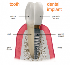 Dental implant explained